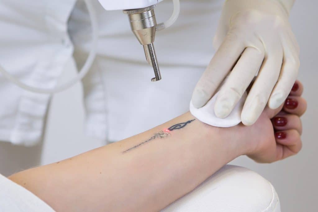Best Laser Tattoo Removal Machines