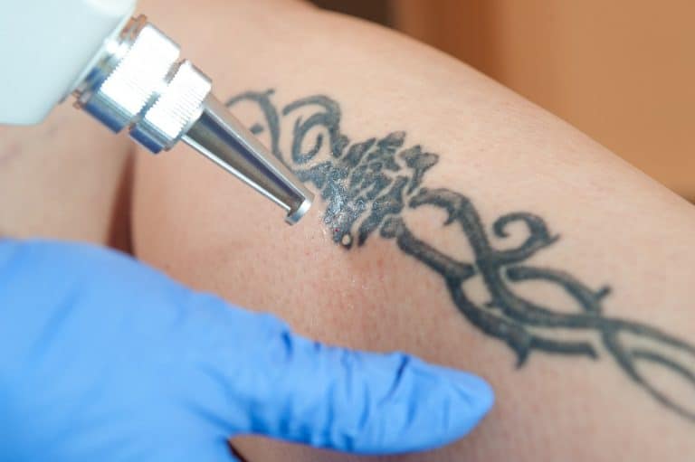 Is Laser Tattoo Removal Expensive? (And Other Removal Options)