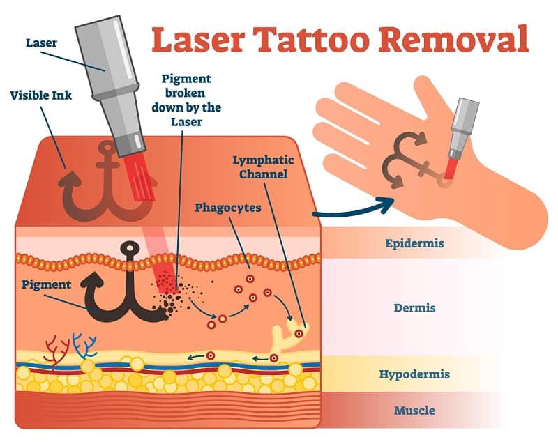 Wavelengths, pulses, and energy of laser tattoo removal