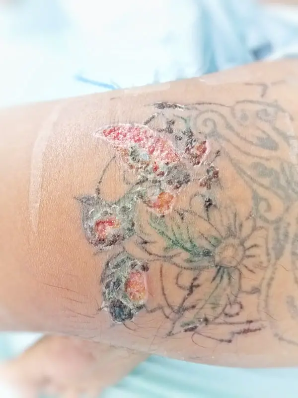Tattoo infection Dermatitis