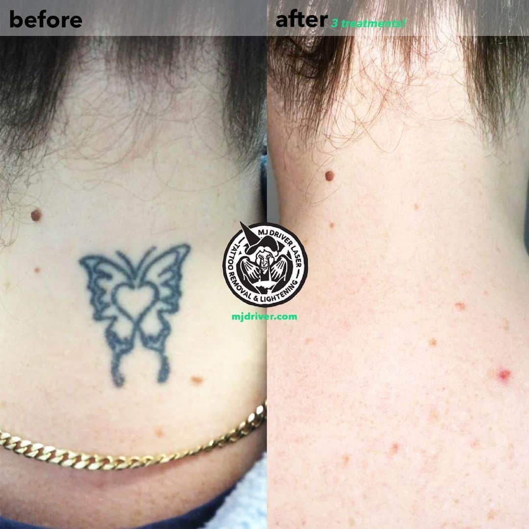 The Easiest and Hardest Tattoo Pigments To Remove Saved Tattoo