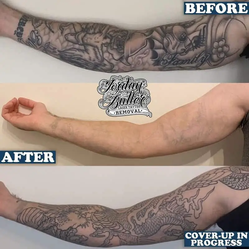 Why You Need Multiple Sessions To Remove a Tattoo Saved Tattoo
